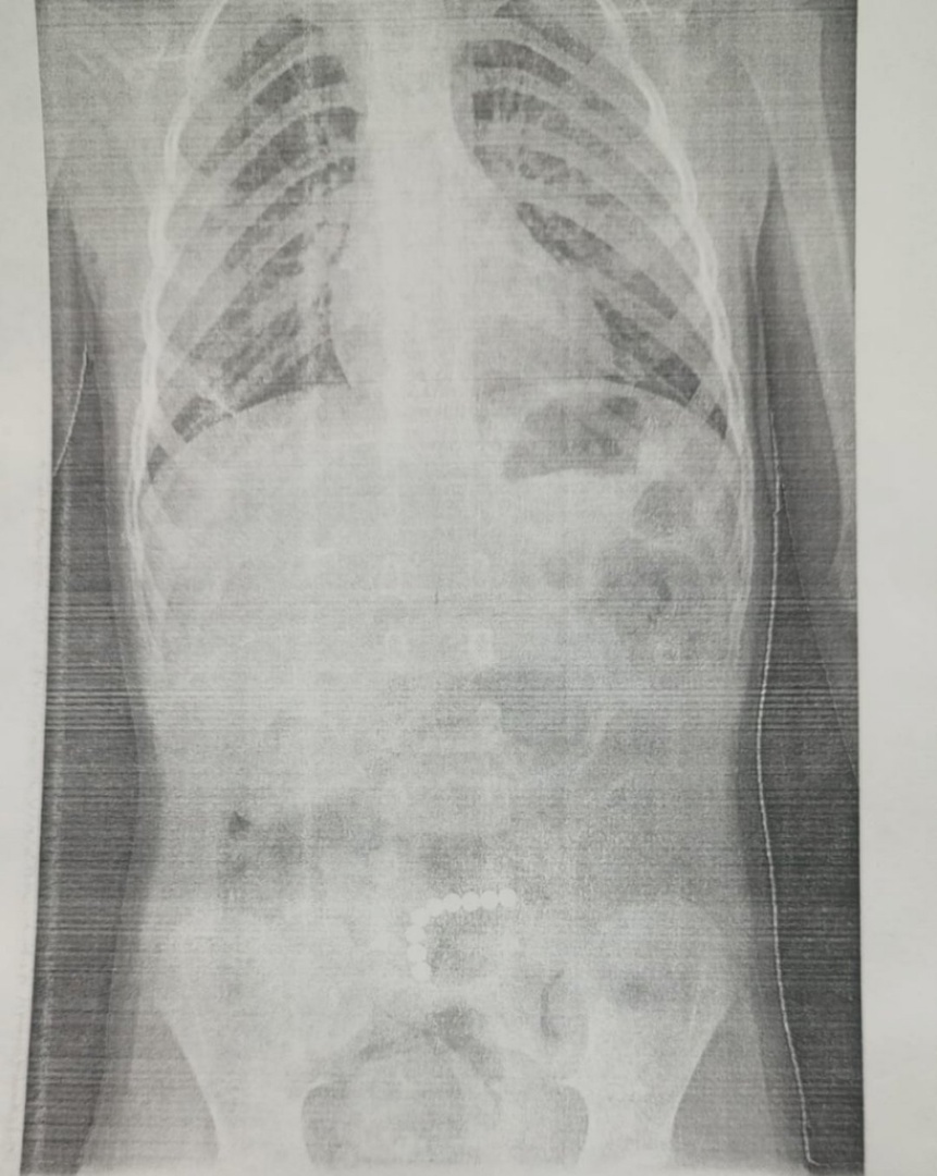 В ОДКБ врачи успешно прооперировали 4-летнего мальчка, проглотившего 9  магнитных шариков